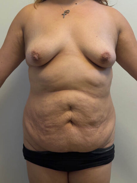 Tummy Tuck case #4865