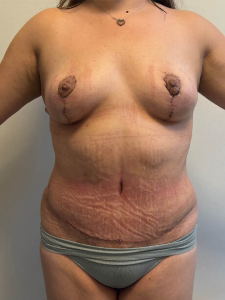 Tummy Tuck case #4865