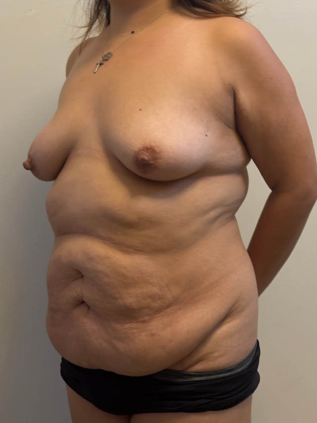 Tummy Tuck case #4865