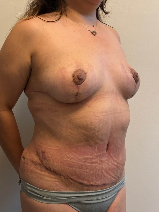 Tummy Tuck case #4865