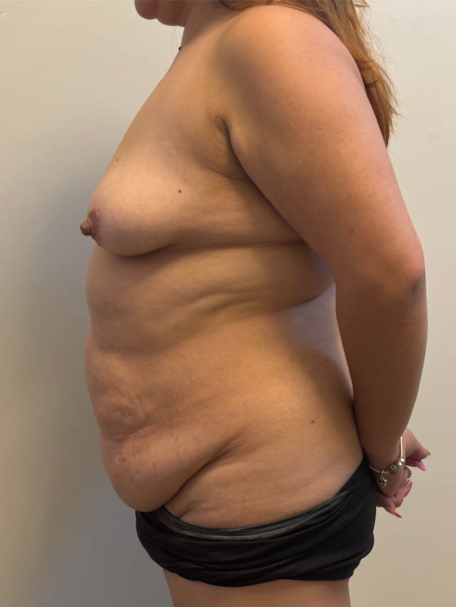 Tummy Tuck case #4865