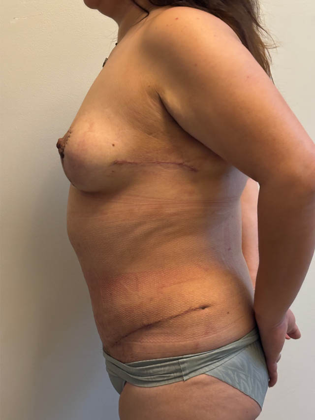 Tummy Tuck case #4865
