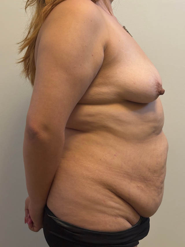 Tummy Tuck case #4865