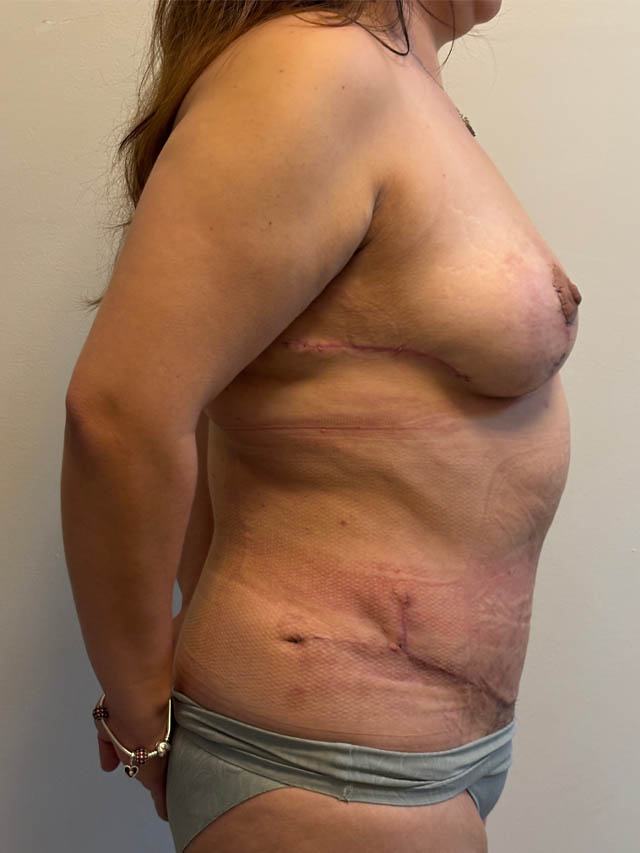 Tummy Tuck case #4865