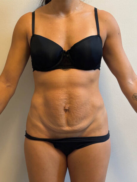 Tummy Tuck case #4876