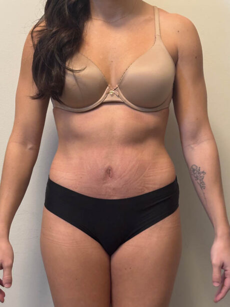 Tummy Tuck case #4876