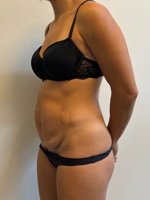 Tummy Tuck case #4876