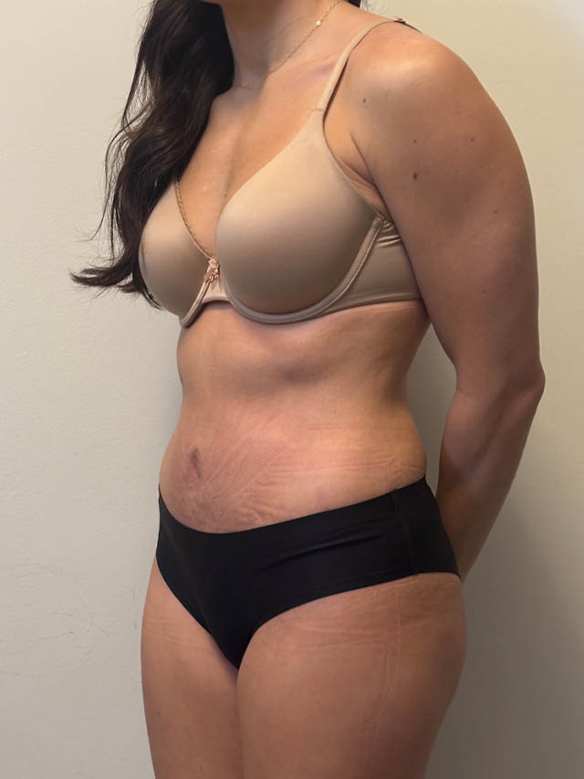 Tummy Tuck case #4876