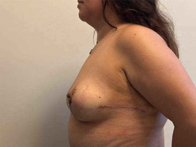Breast Lift case #4700