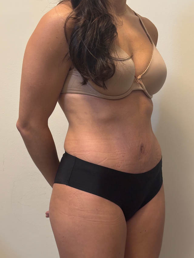 Tummy Tuck case #4876