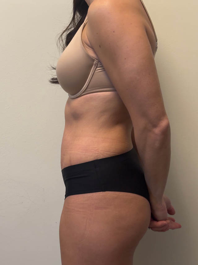Tummy Tuck case #4876