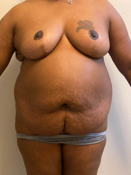 Tummy Tuck case #4887