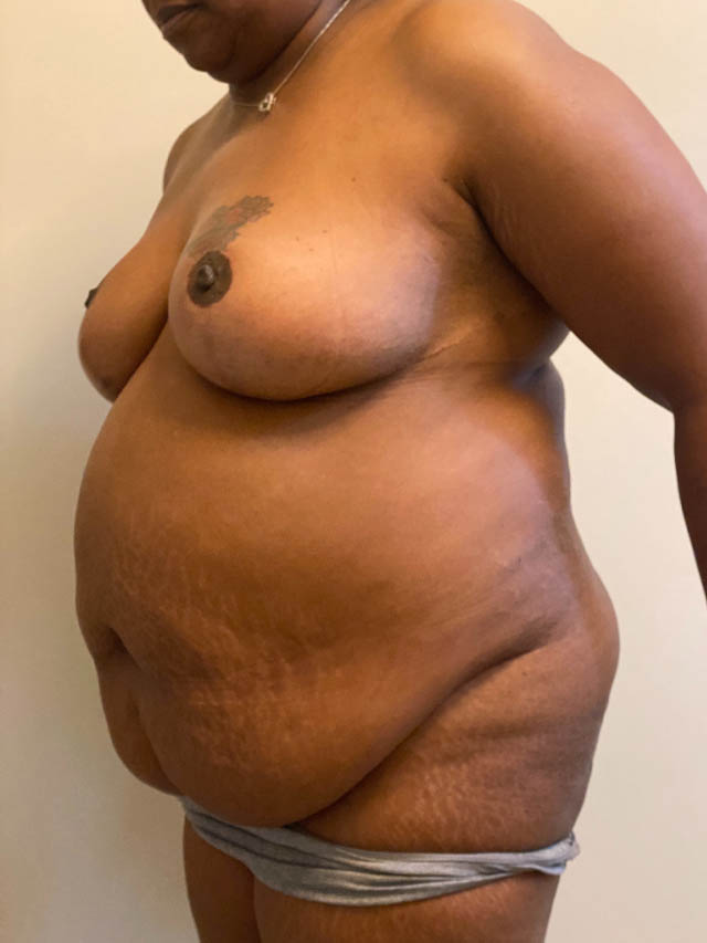 Tummy Tuck case #4887