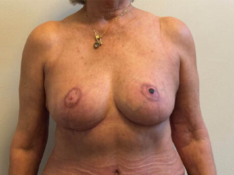 Breast Reduction case #4718