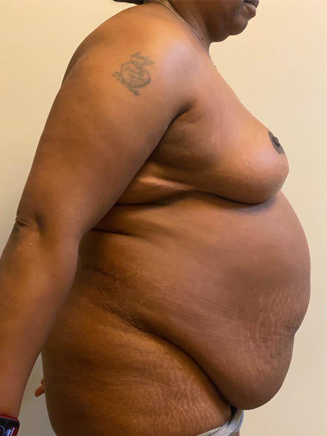 Tummy Tuck case #4887