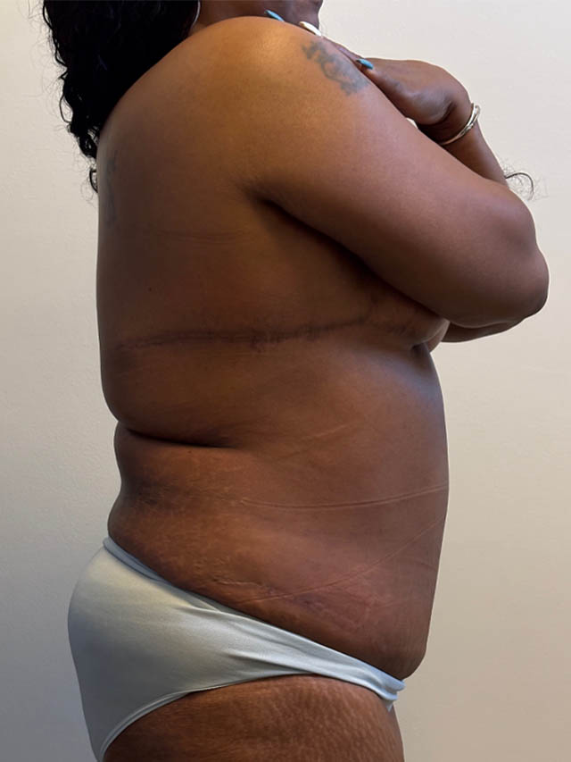 Tummy Tuck case #4887