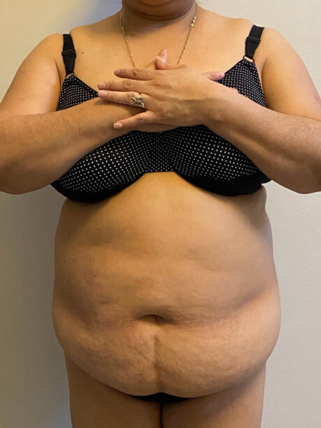 Tummy Tuck case #4894