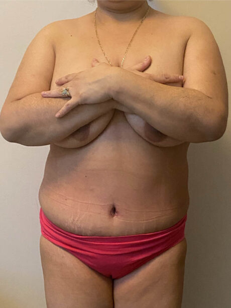 Tummy Tuck case #4894