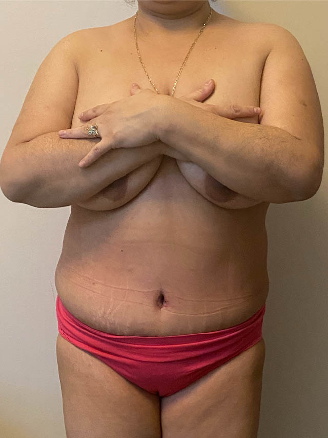 Tummy Tuck case #4894