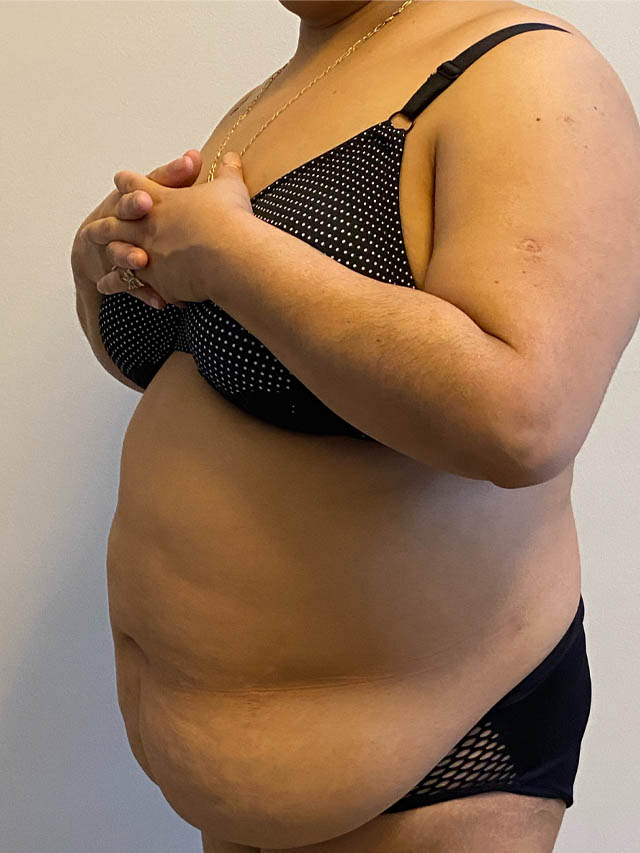 Tummy Tuck case #4894