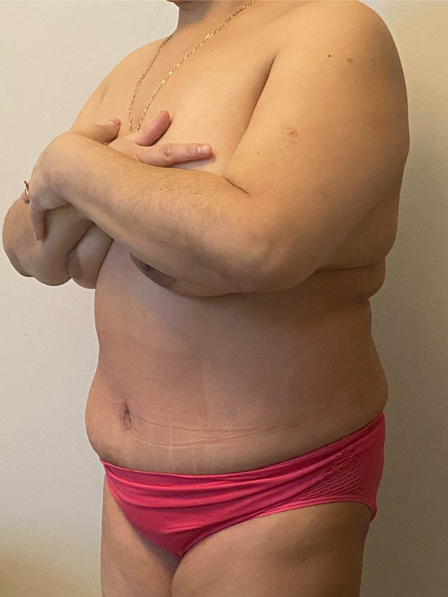 Tummy Tuck case #4894