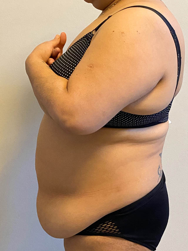 Tummy Tuck case #4894