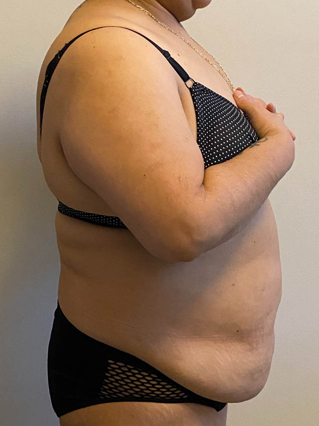 Tummy Tuck case #4894