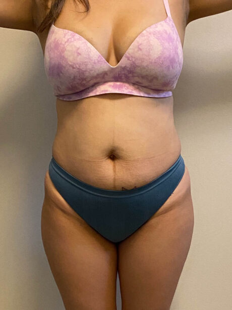 Tummy Tuck case #4903