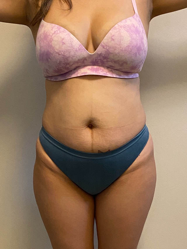 Tummy Tuck case #4903