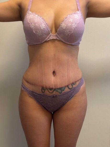 Tummy Tuck case #4903