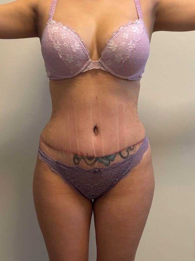 Tummy Tuck case #4903