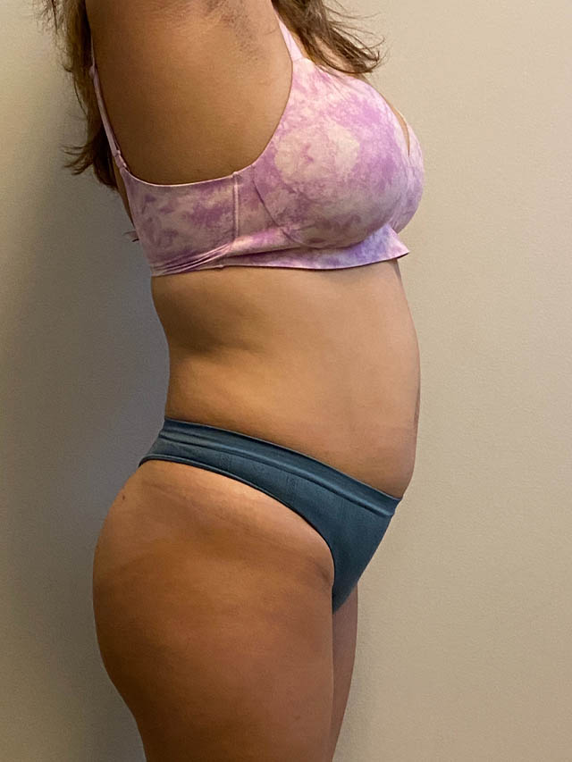 Tummy Tuck case #4903