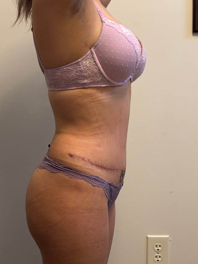 Tummy Tuck case #4903