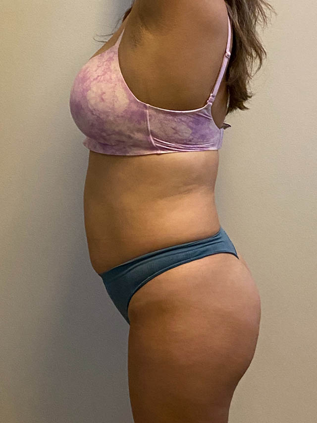 Tummy Tuck case #4903