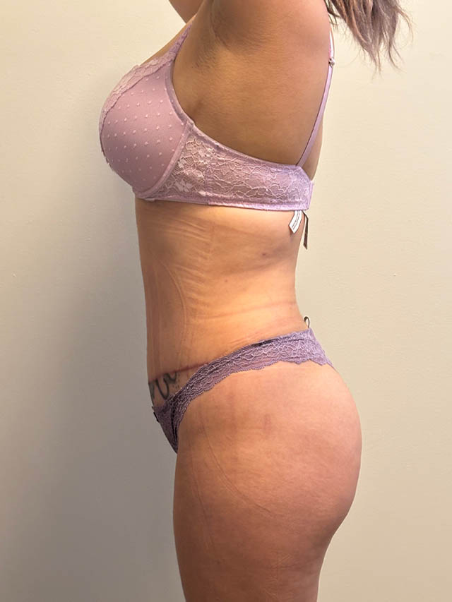 Tummy Tuck case #4903