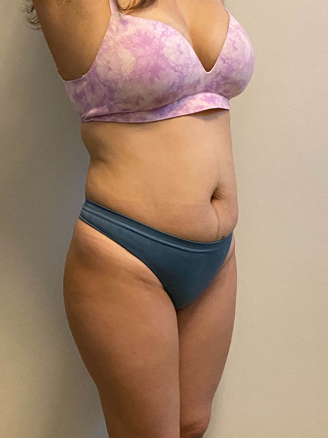 Tummy Tuck case #4903
