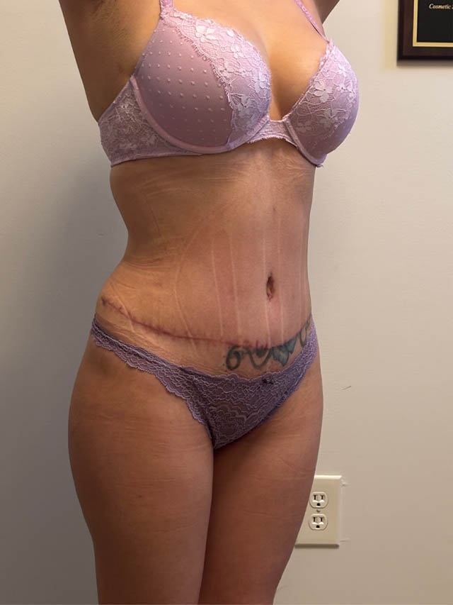 Tummy Tuck case #4903