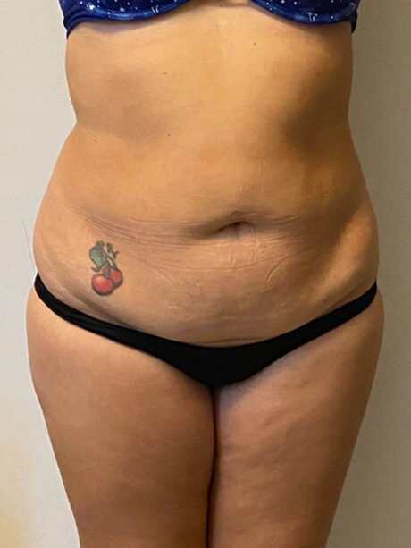Tummy Tuck case #4912