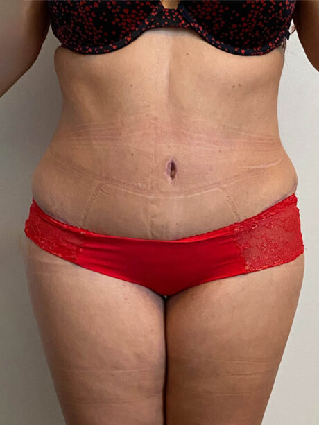 Tummy Tuck case #4912