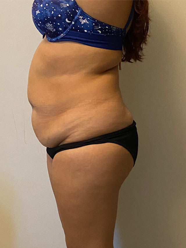 Tummy Tuck case #4912