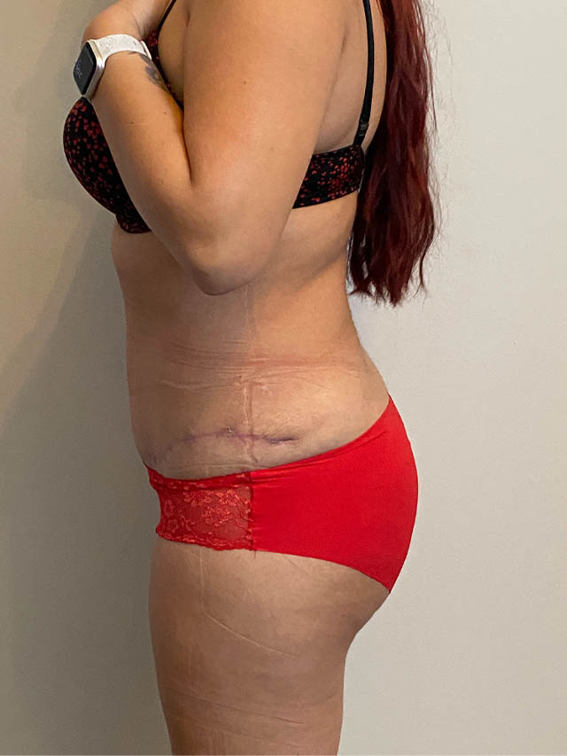 Tummy Tuck case #4912