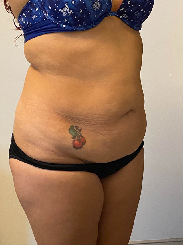 Tummy Tuck case #4912
