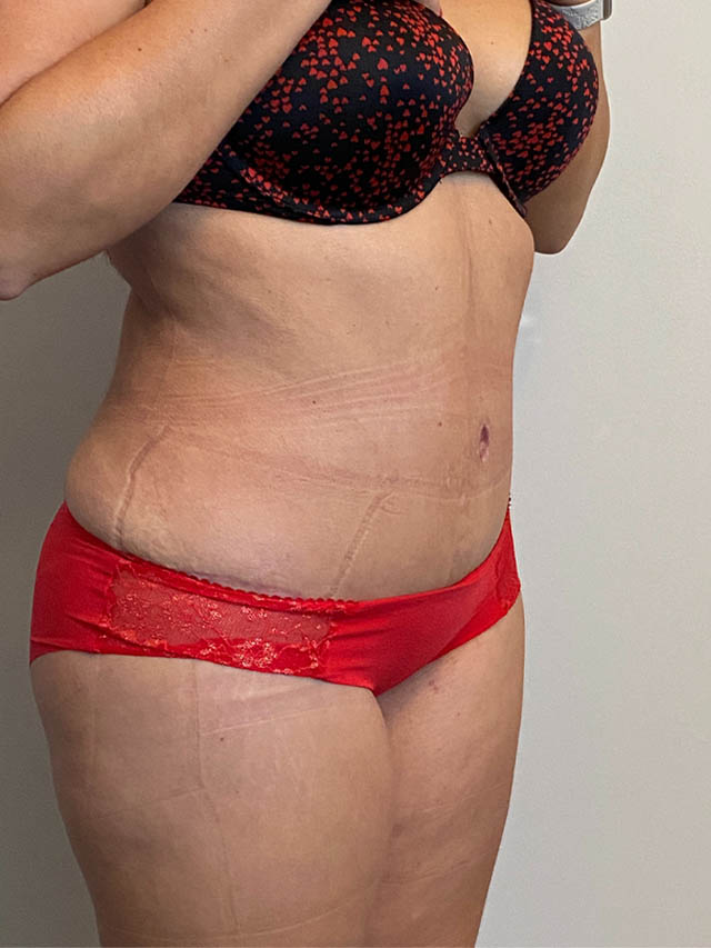 Tummy Tuck case #4912
