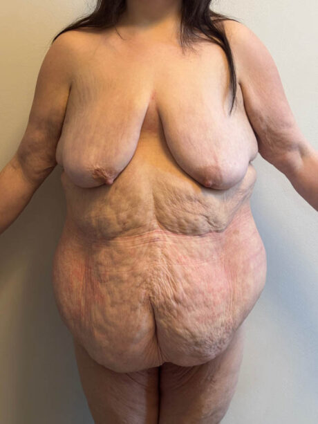 Tummy Tuck case #4921