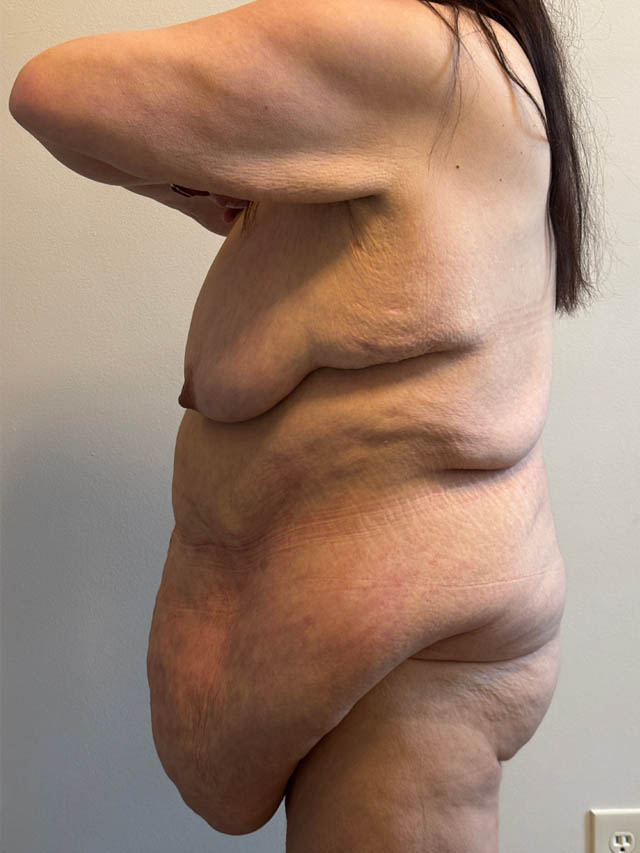 Tummy Tuck case #4921