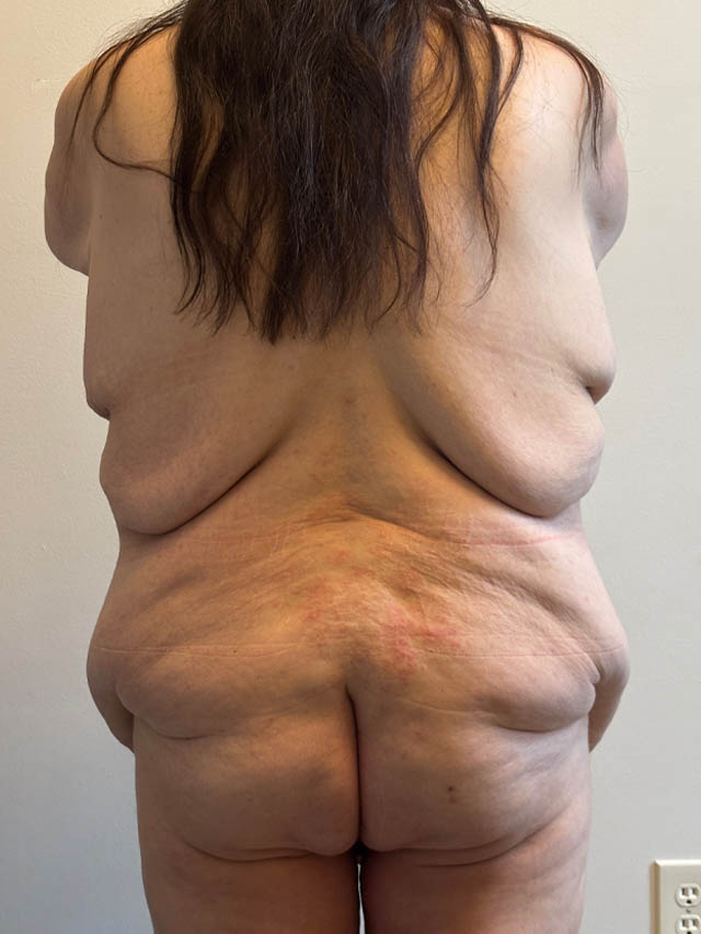 Tummy Tuck case #4921