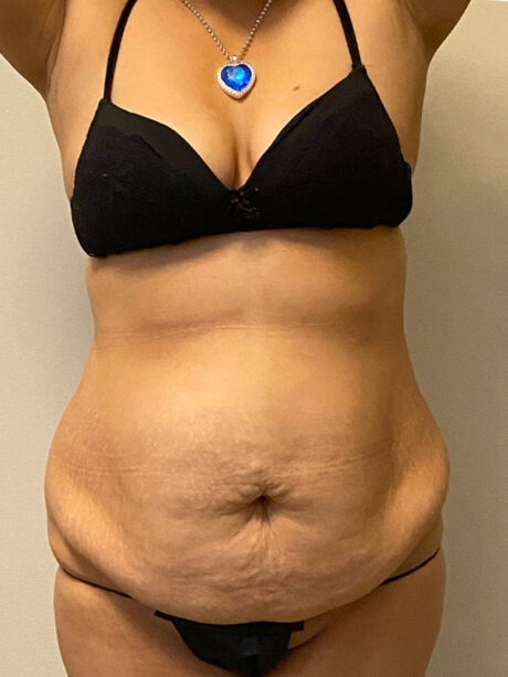 Tummy Tuck case #4934
