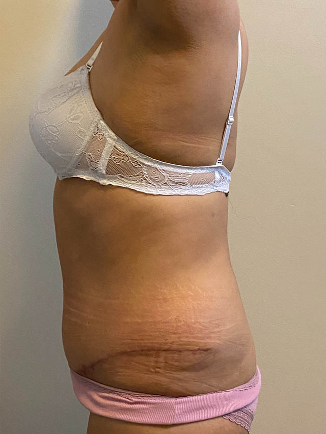 Tummy Tuck case #4934