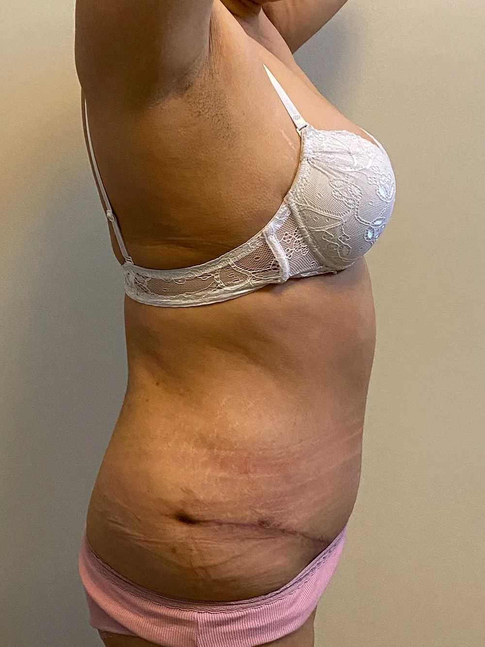 Tummy Tuck case #4934