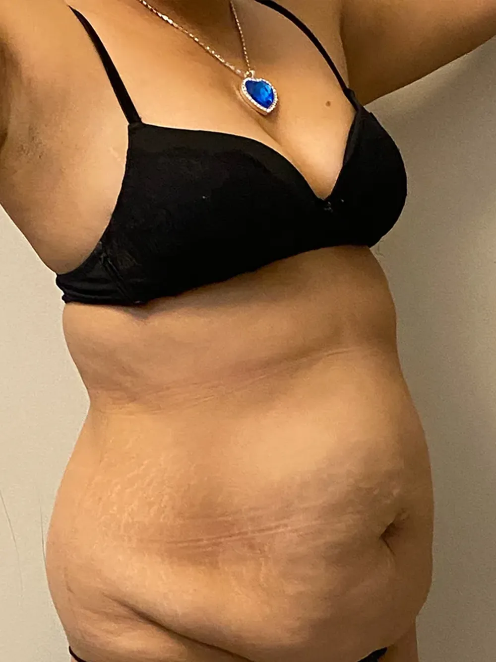 Tummy Tuck case #4934
